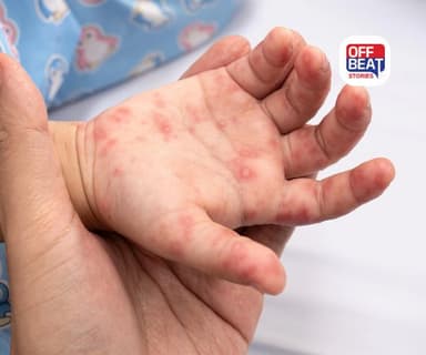 બાળકોથી પુખ્ત વયના લોકોમાં વાયરલ ઇન્ફેકશન